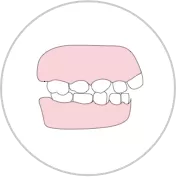 
Anterior deep overjet