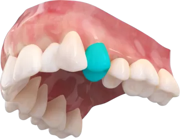 日用型隱形牙套