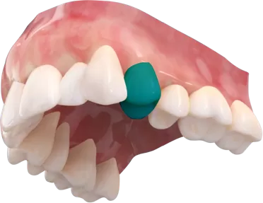 夜用型隱形牙套