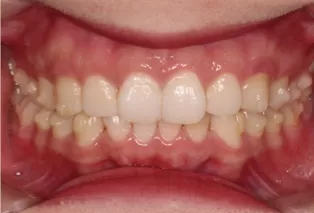 Intraoral photos after treatment