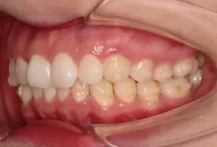 Intraoral photos after treatment