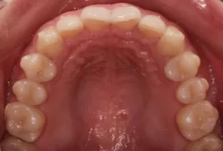 Intraoral photos after treatment