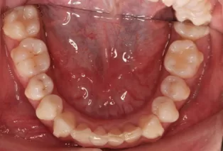 Intraoral photos after treatment