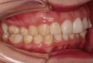 Intraoral photos after treatment