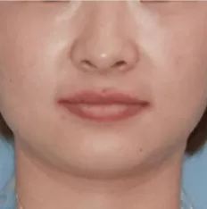 Facial photos before treatment