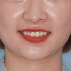 Facial photos before treatment