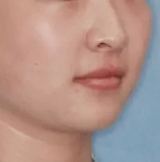 Facial photos before treatment