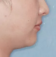 Facial photos before treatment