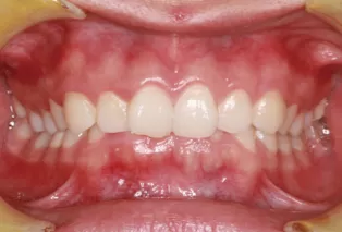 Intraoral photos