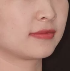 Facial photos before treatment