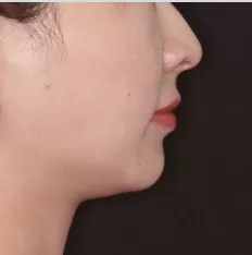 Facial photos before treatment