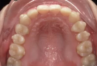 Intraoral photos