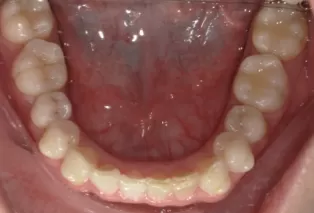 Intraoral photos
