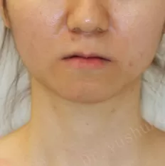 Facial photos before treatment