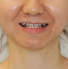 Facial photos before treatment