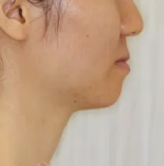 Facial photos before treatment