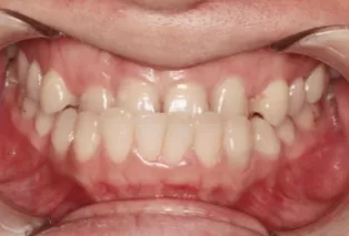 Intraoral photos