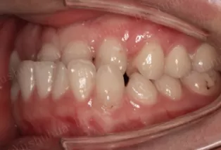 Intraoral photos