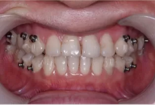 Intraoral photos