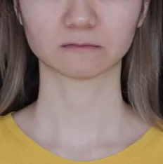 Facial photos before treatment