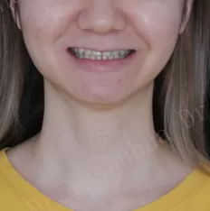 Facial photos before treatment