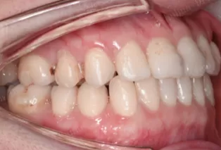 Intraoral photos after treatment