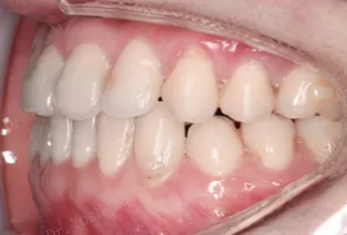 Intraoral photos after treatment