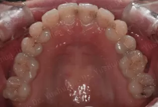Intraoral photos after treatment
