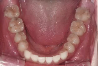 Intraoral photos after treatment