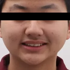 Facial photos before treatment