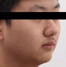 Facial photos before treatment