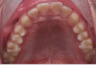 Intraoral photos