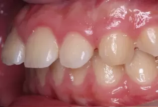 Intraoral photos