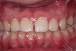 Intraoral photos