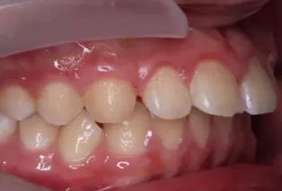 Intraoral photos