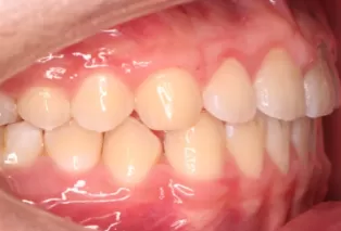 Intraoral photos after treatment