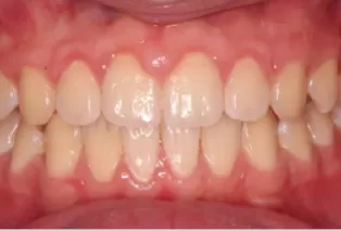 Intraoral photos after treatment