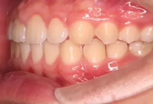 Intraoral photos after treatment