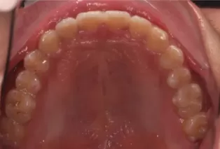 Intraoral photos after treatment