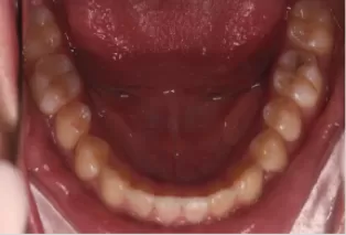 Intraoral photos after treatment