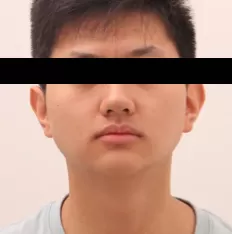 Facial photos before treatment