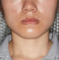 Facial photos before treatment