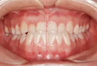 Intraoral photos