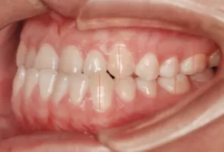 Intraoral photos