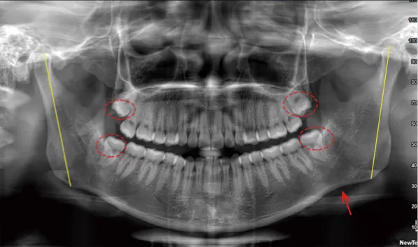 X-rays before treatment
