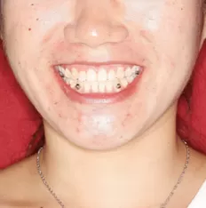 Facial photos before treatment