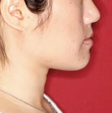 Facial photos before treatment