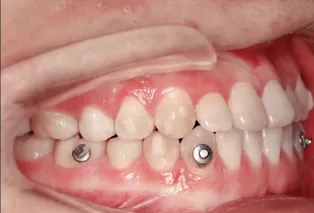 Intraoral photos after treatment