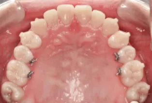 Intraoral photos after treatment