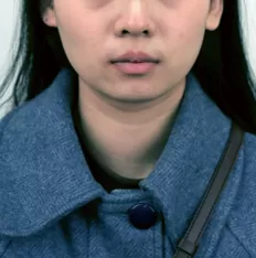 Facial photos before treatment